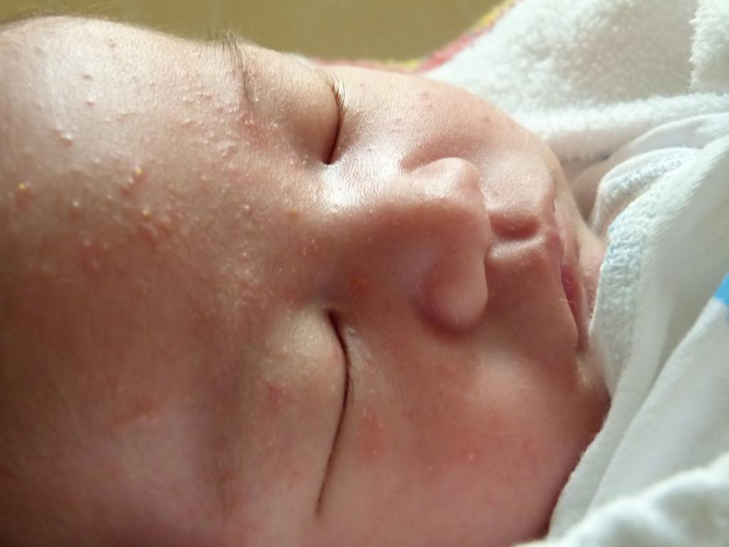 У новорожденного ребенка угревая сыпь thumbnail