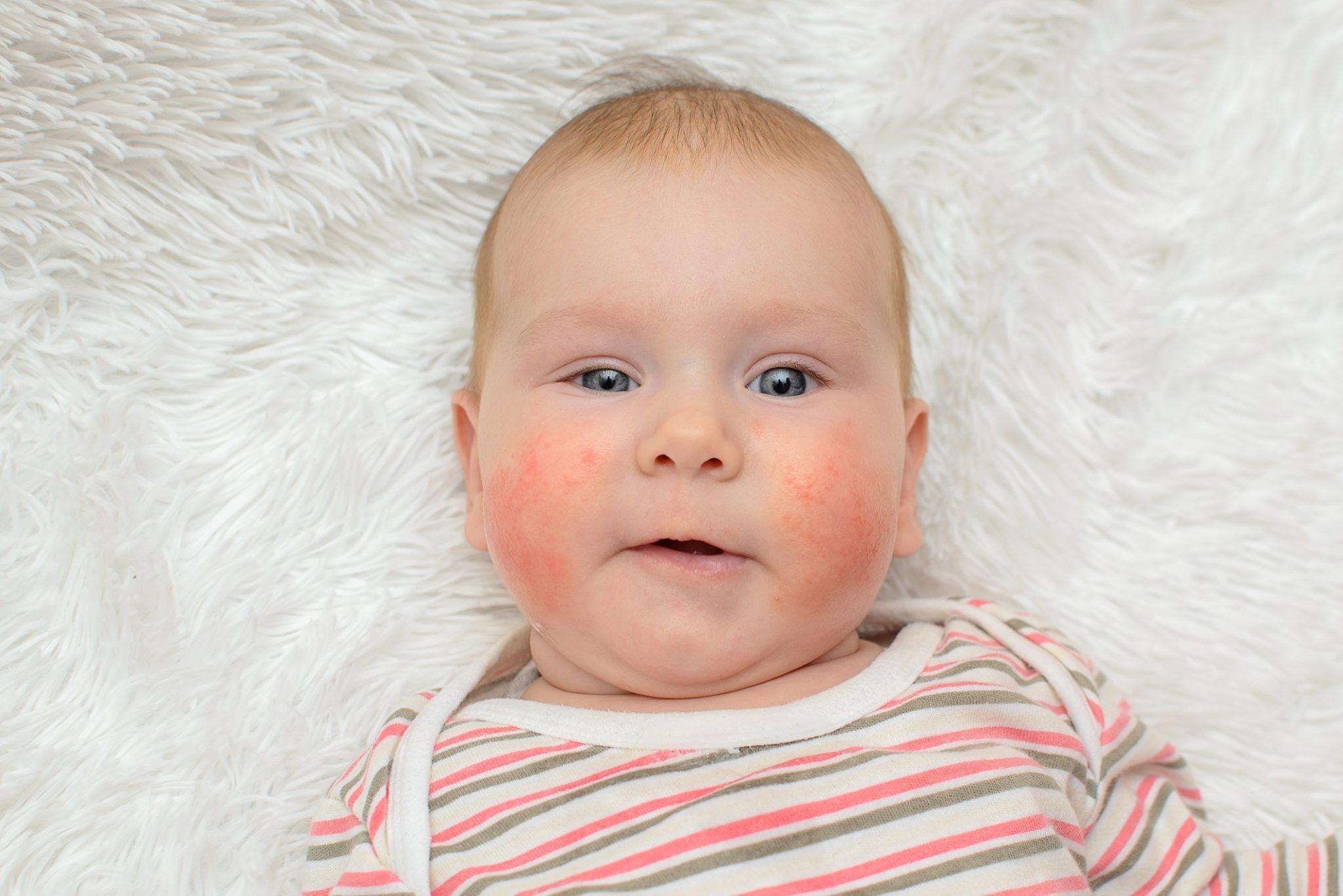 Ребенок чешет лицо от аллергии thumbnail