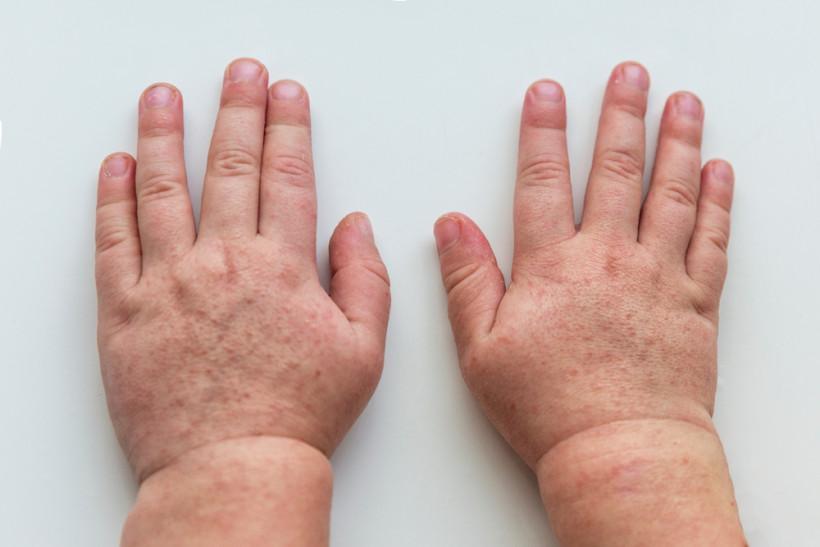 Причина шелушения кожи рук у ребенка причины thumbnail