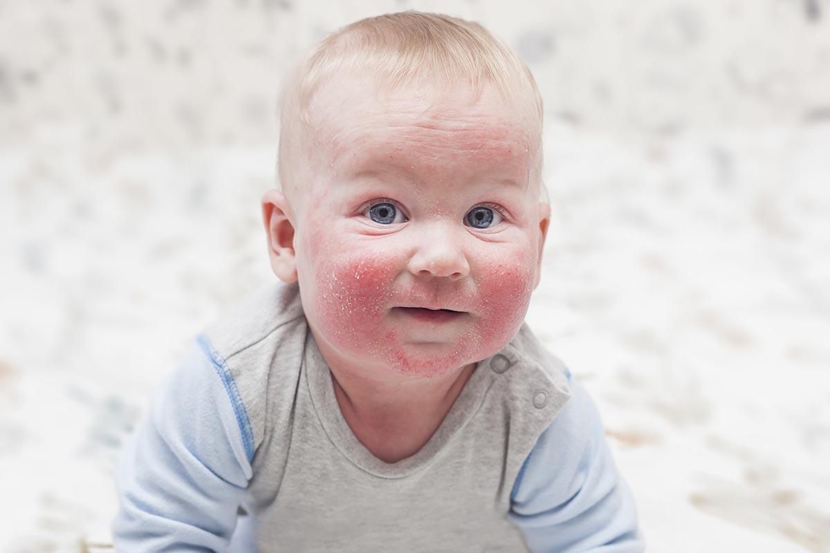 Ребенку 1 месяц сыпь на лице и голове и ушах причины thumbnail