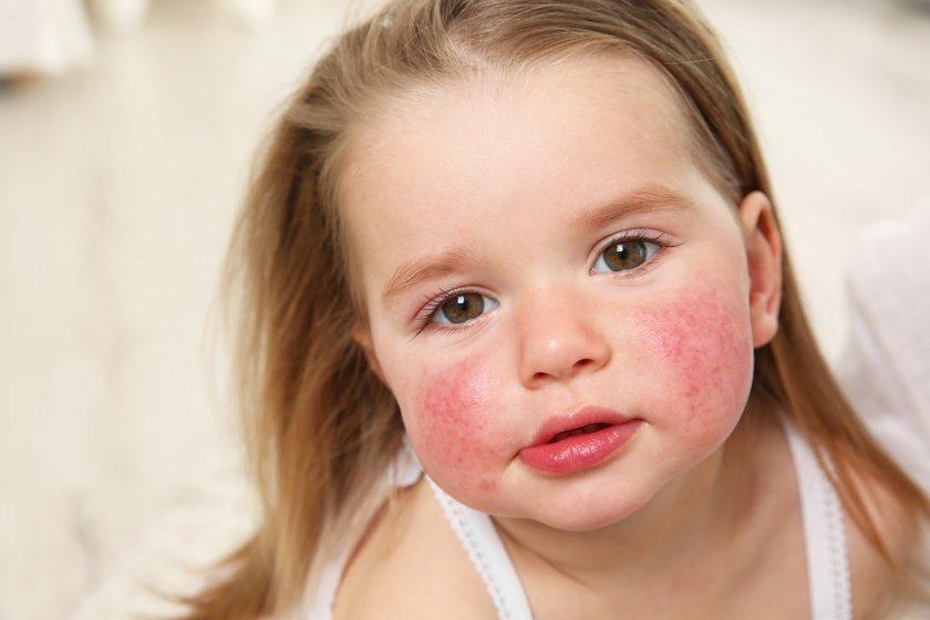 Аллергия на лице и голове у новорожденного thumbnail