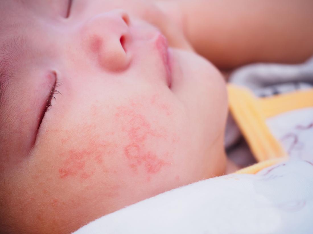 Аллергия у ребенка сыпь на щечках thumbnail