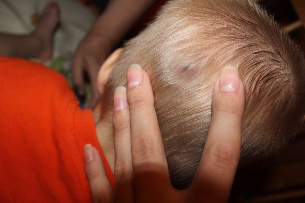 У ребенка шишка на голове и температура thumbnail