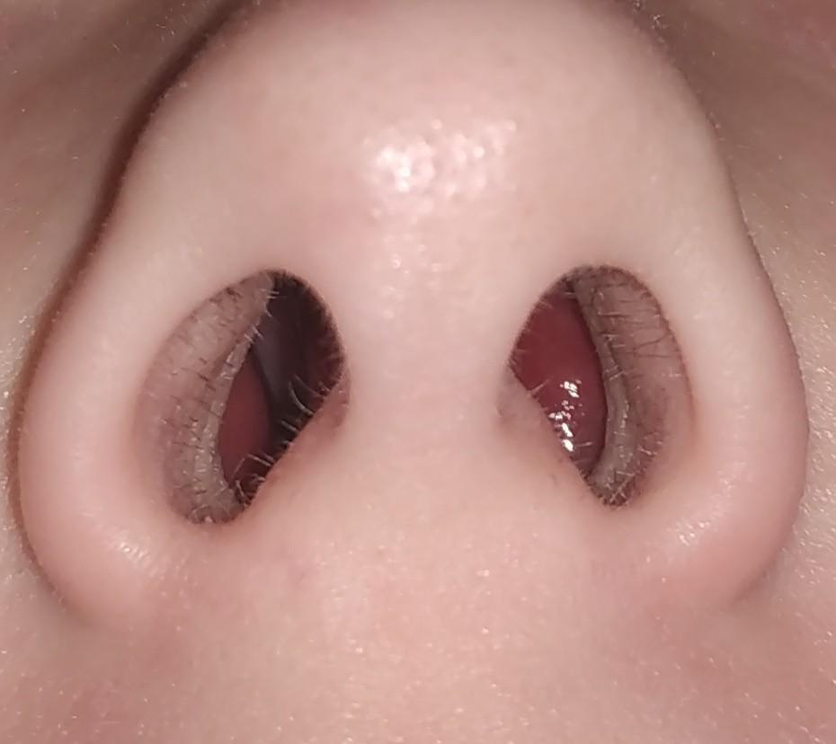 Чем лечить отек слизистой носа у новорожденного thumbnail