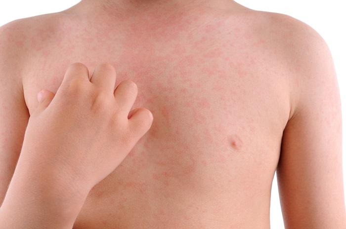 Аллергия на коже красные пятна у грудничка thumbnail