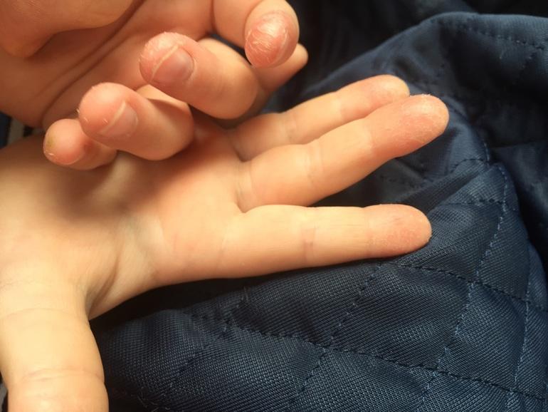 Трескаются пальцы на руках у малыша