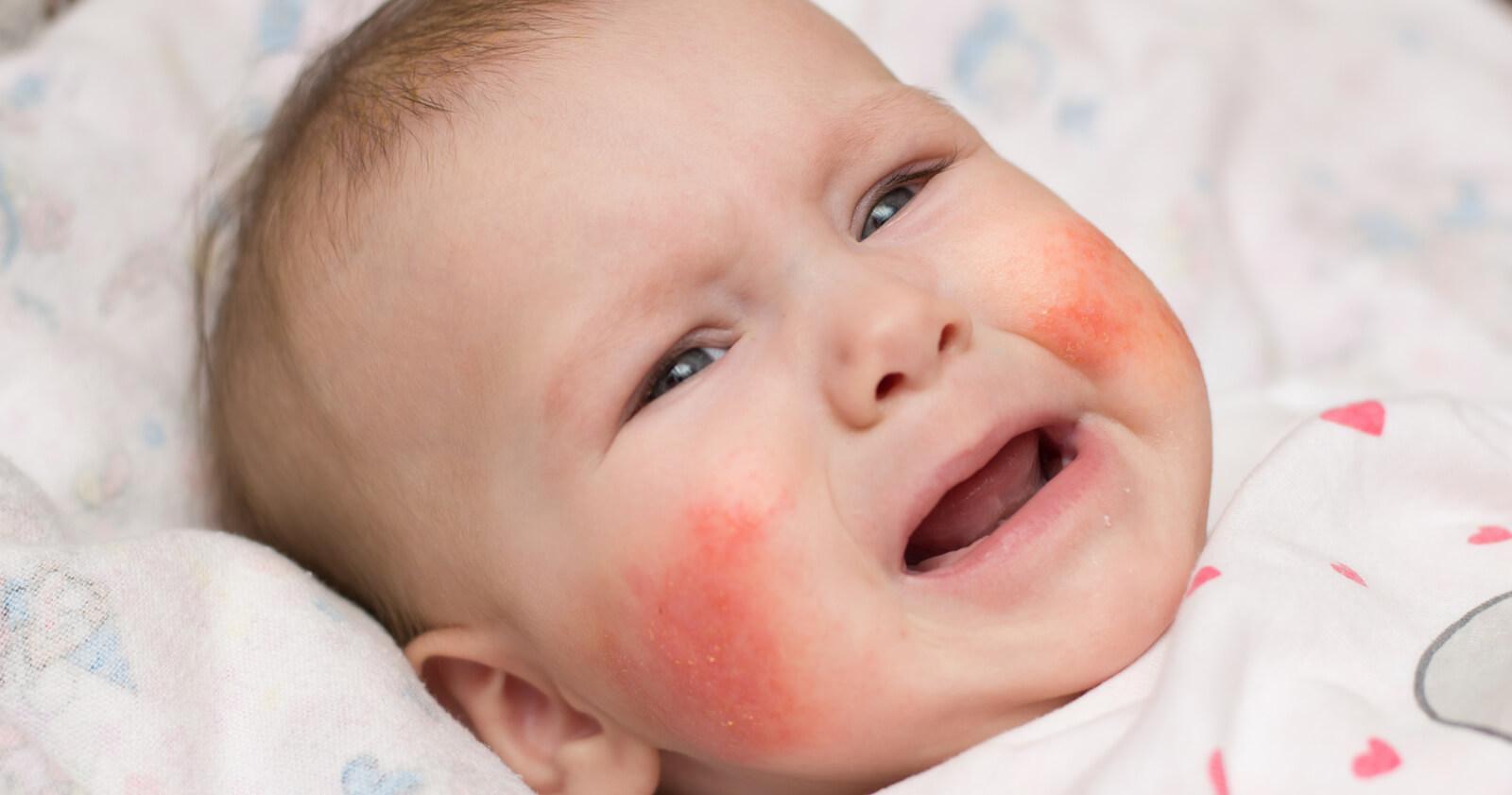 Красная кожа на лице у младенца thumbnail
