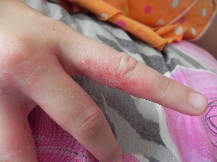 У ребенка шелушится и трескается кожа на пальце руки что это thumbnail