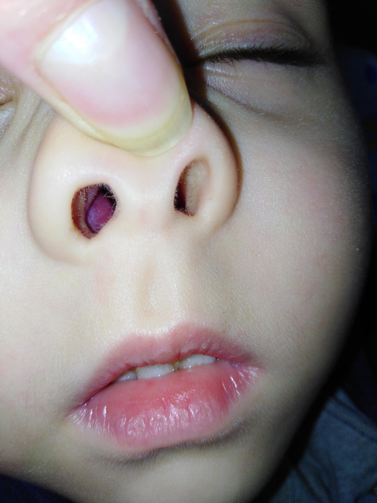 Отек слизистой носа у новорожденного после родов причины и лечение thumbnail