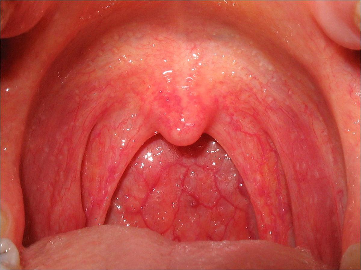 Вирусная сыпь в горле у ребенка thumbnail
