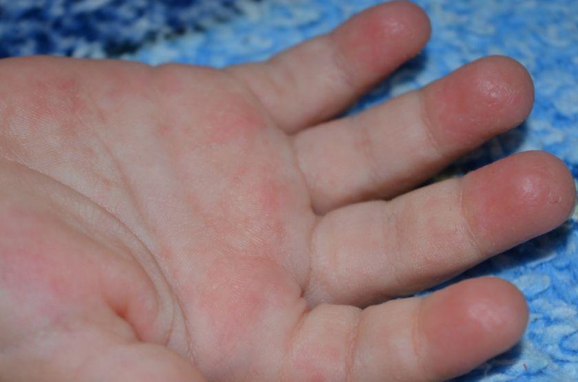 Сухая кожа на кончиках пальцев рук у ребенка руки thumbnail