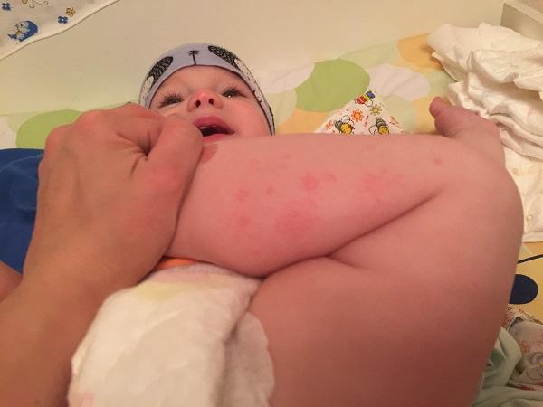 Ребенку 6 месяцев сыпь на ногах thumbnail