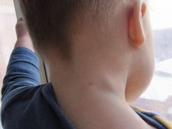 У ребенка 5 лет опухла шея thumbnail
