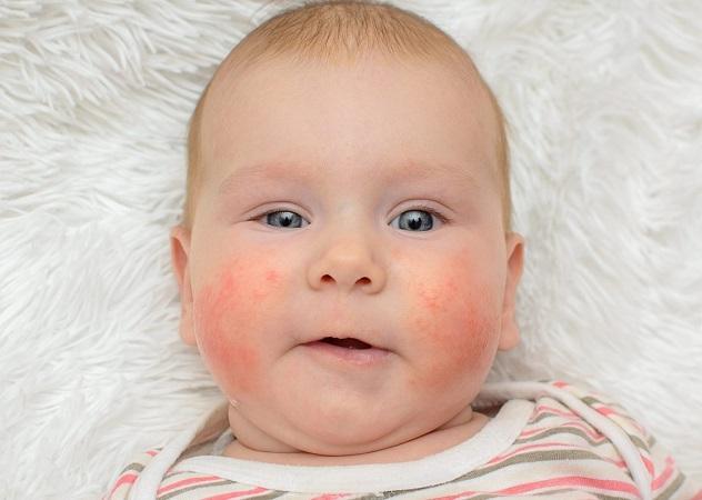 У ребенка увеличены лимфоузлы на шее сыпь thumbnail