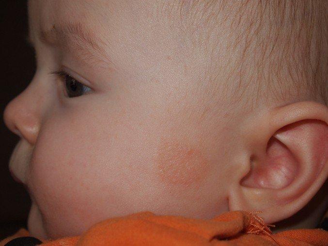 Шершавое пятно на коже у ребенка на бедре thumbnail