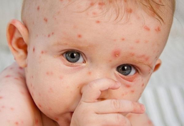 Увеличены лимфоузлы на шее у ребенка аллергия thumbnail