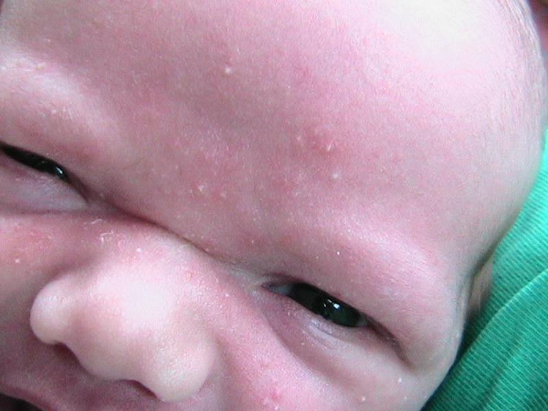 Красные прыщики на лице у ребенка 1 год 3 месяца thumbnail
